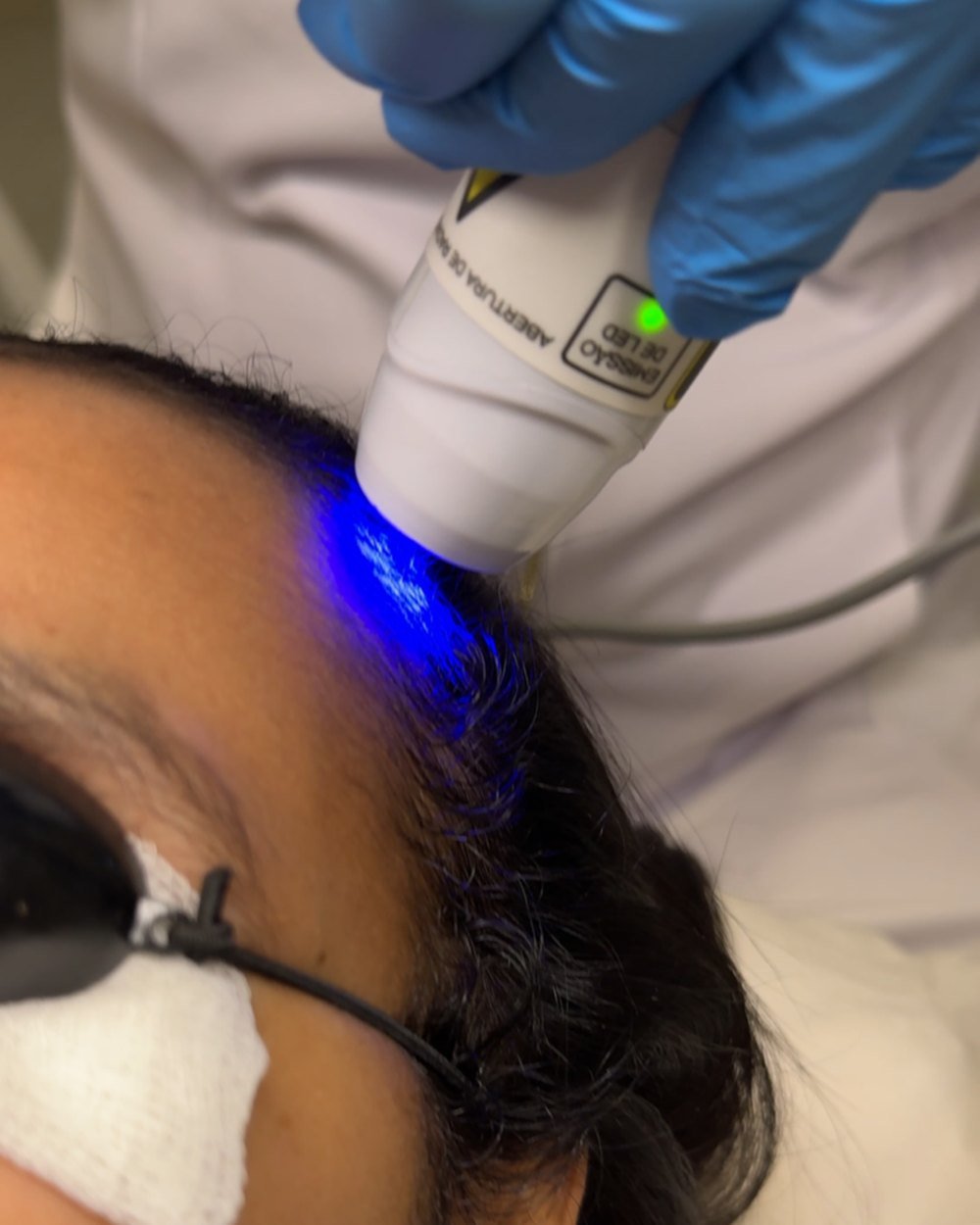Caneta de fotobiomodulação com o LED aceso sobre a linha frontal do couro cabeludo