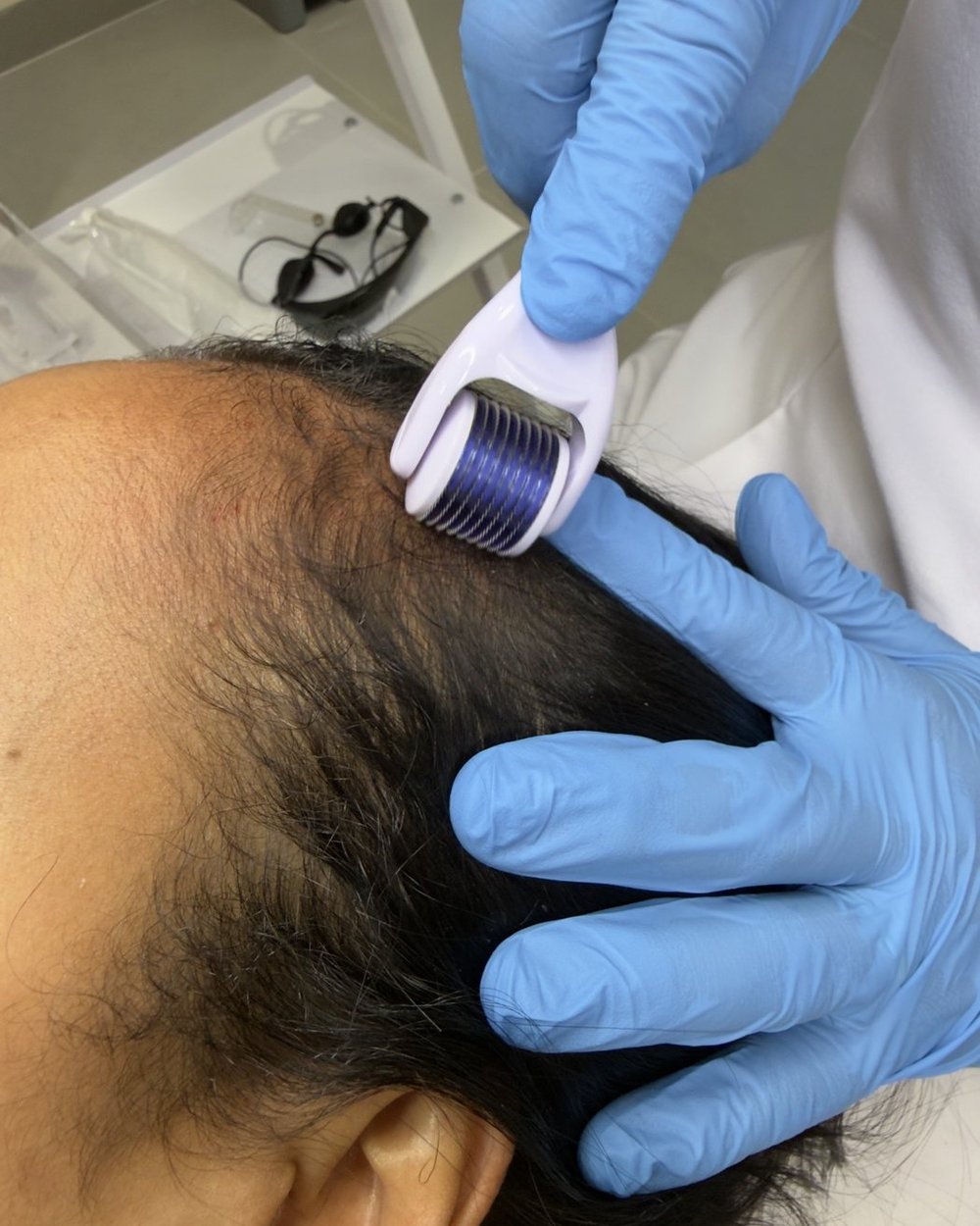 Microagulhamento capilar aplicado com roller na linha frontal do couro cabeludo